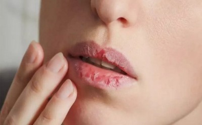 Bị bong da môi thường xuyên là thiếu chất gì, bệnh gì và cách chữa trị