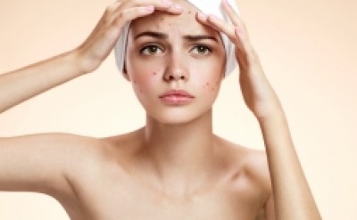 Không biết cách chăm sóc da sau khi nặn mụn này thì đừng hỏi tại sao mặt đầy sẹo thâm
