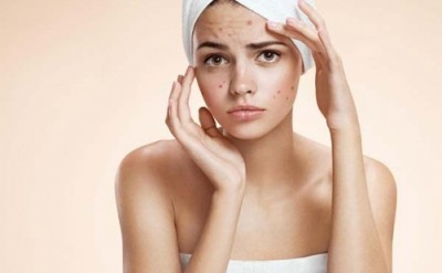 5 "Quy tắc vàng" để chăm sóc da sau khi nặn mụn